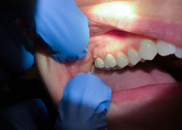 Best Knocked-Out Tooth (Avulsed Tooth) Treatment in New California, OH